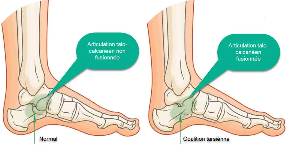 Tarsal Coalition